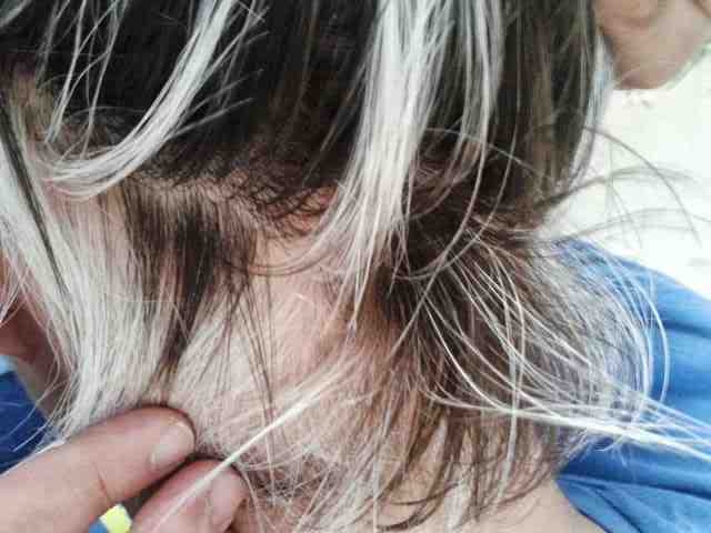 haaruitval bij jongeren, haarproblemen, haarinhammen, kale plekken, verkleuring